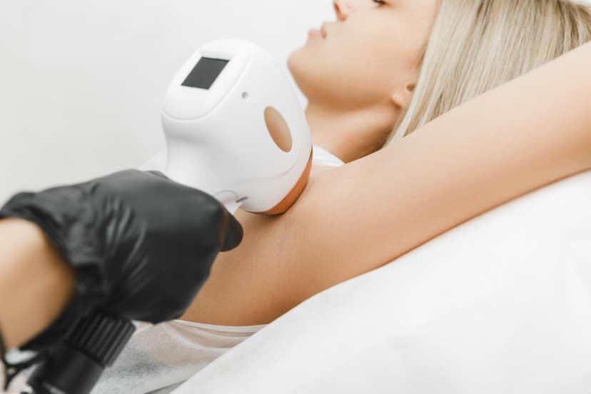 Kaenlaaluste laserepilatsioon